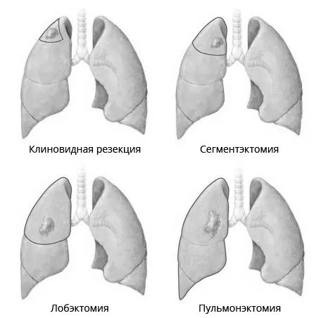 лікування