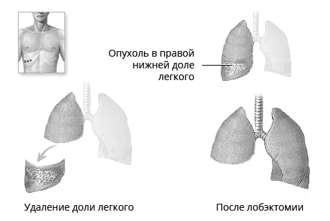 стадія раку легенів