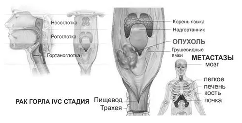 Рак горла 4 ступеня: прогноз прогноз