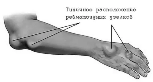 симптоми