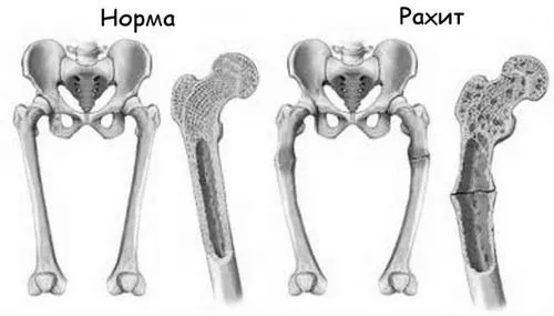 рахіт