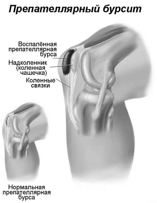 як лікувати препателлярний бурсит