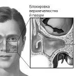 синусит симптоми лікування ознаки профілактика інгаляції