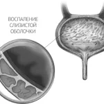 чи можна лікувати печію содою при вагітності