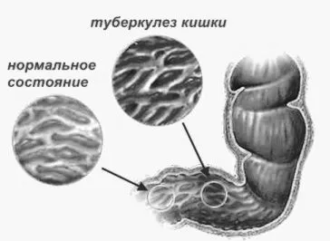туберкульоз кишечника лікування