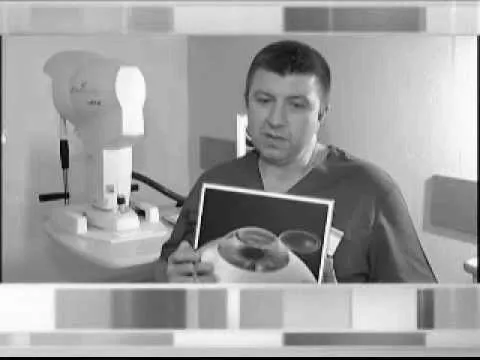 складний міопічний астигматизм обох очей