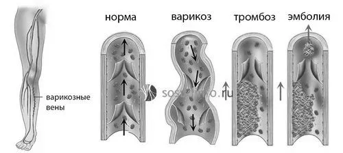 симптоми