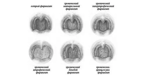 хронічний фарингіт у дитини