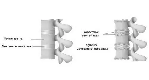 як лікувати хондроз комірцевої зони