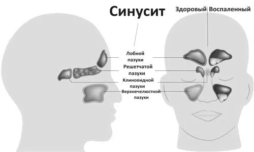Синусит при вагітності: причини, симптоми, лікування, ускладнення, небезпека як лікувати гострий синусит при вагітності