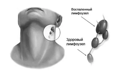 лімфовузлів