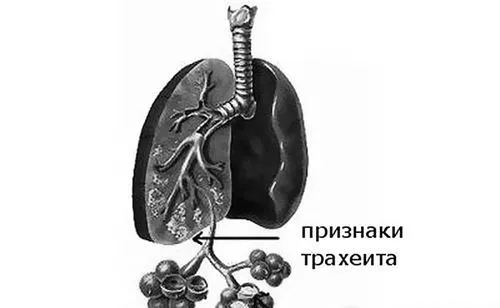 трахеїт