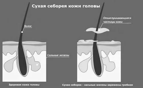 як лікувати себорею шкіри голови народними засобами