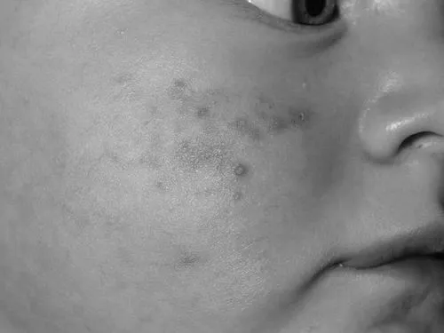 як лікувати кропивницю в однорічної дитини