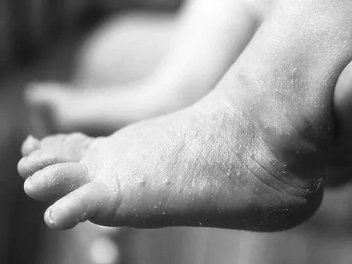 як лікувати кропивницю в однорічної дитини