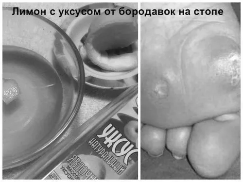 Видалення бородавок в домашніх умовах аптечними або народними засобами лікування шіпіци на нозі в домашніх умовах