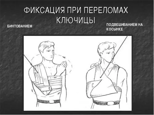 Травми ключиці: лікування, симптоми, перша допомога при ушкодженнях і ударах ключиці як вилікувати забій ключиці