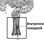 Внутрішній і зовнішній геморой: чим відрізняється лікування геморой