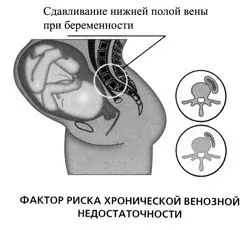 варикозне розширення вен при вагітності