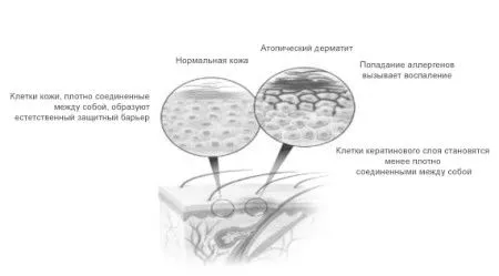 як лікувати дерматит у вухах