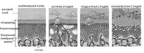варикозна