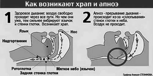як лікувати хропіння при вагітності