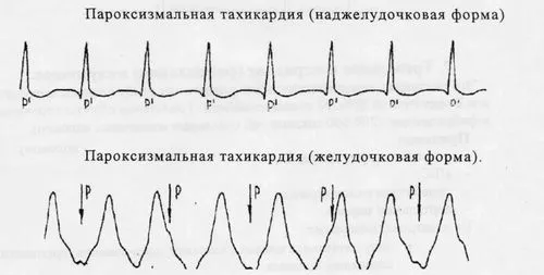 напад тахікардії