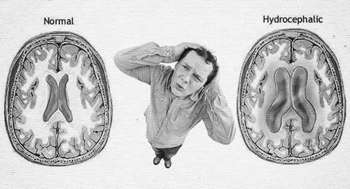 Внутрішньочерепний тиск: народне лікування внутрішньочерепний