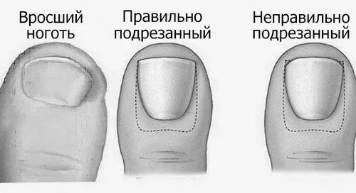 ніготь