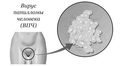 як лікувати папіломи в матці