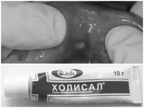 холісал стоматит діти дитина відгуки лікування застосування інструкція