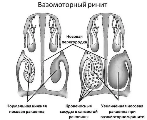риніт