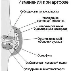 артроз лікувати вдома