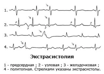 Болі в серці при остеохондрозі: причини і лікування болі в серці при остеохондрозі