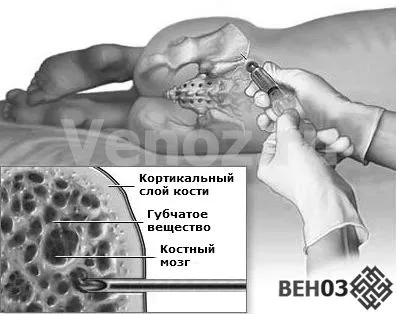 апластична