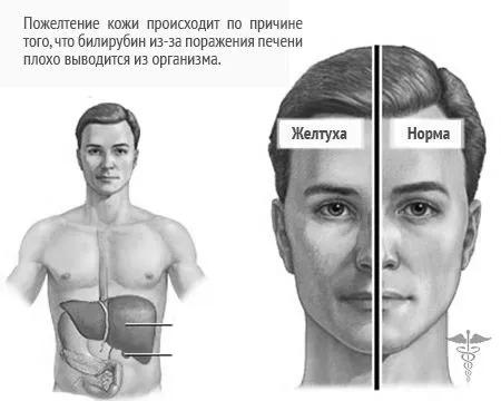 як лікувати печінкову жовтяницю