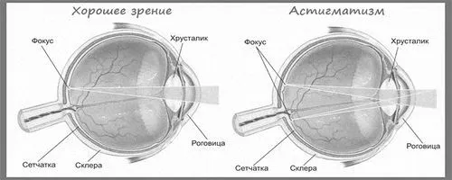 як вилікувати астигматизм Бейтс