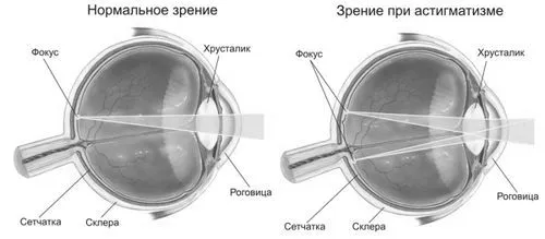 лазером