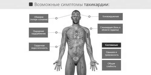 невідкладна допомога при пароксизмальної шлуночкової тахікардії