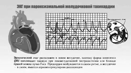 шлуночкова