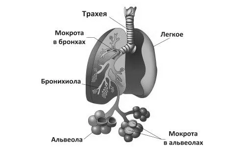 як лікувати атипову пневмонію