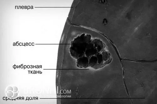 легенів
