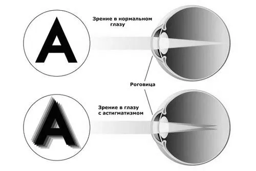 астигматизм