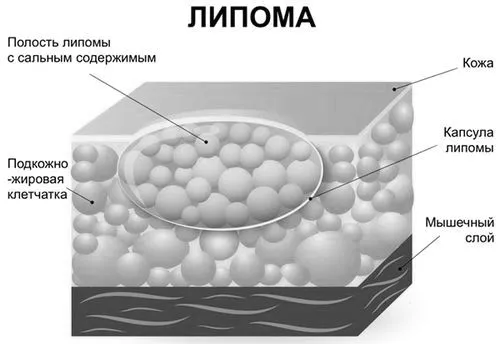 жировик