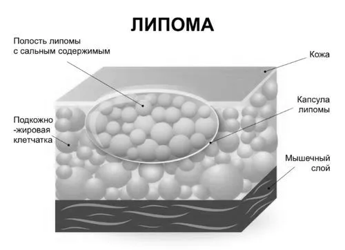ніж лікувати жировик за вухом