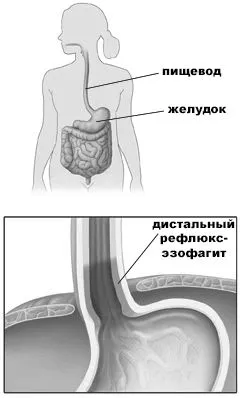 езофагіт