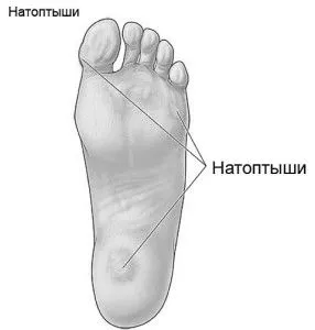 як лікувати натоптиші