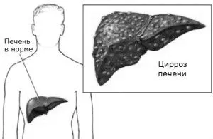 Цироз печінки на останній стадії: симптоми і лікування стадії