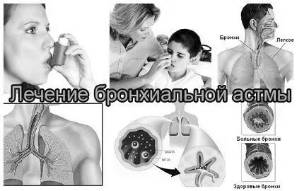 астма