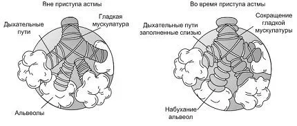 бронхіальна астма лікування дитина препарати інгалятор